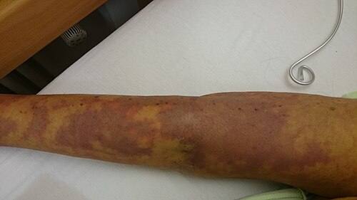 Micrograph of microthrombi associated with sepsis