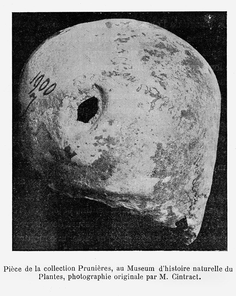 Trephined skull from the Neolithic period, with healed bone showing the patient survived