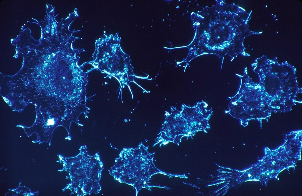 Cancer cells under a fluorescence microscope