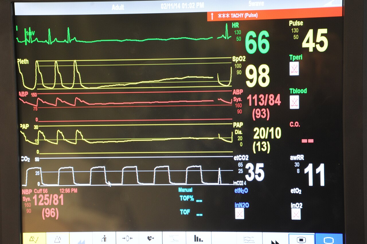 A patient monitor showing vital signs